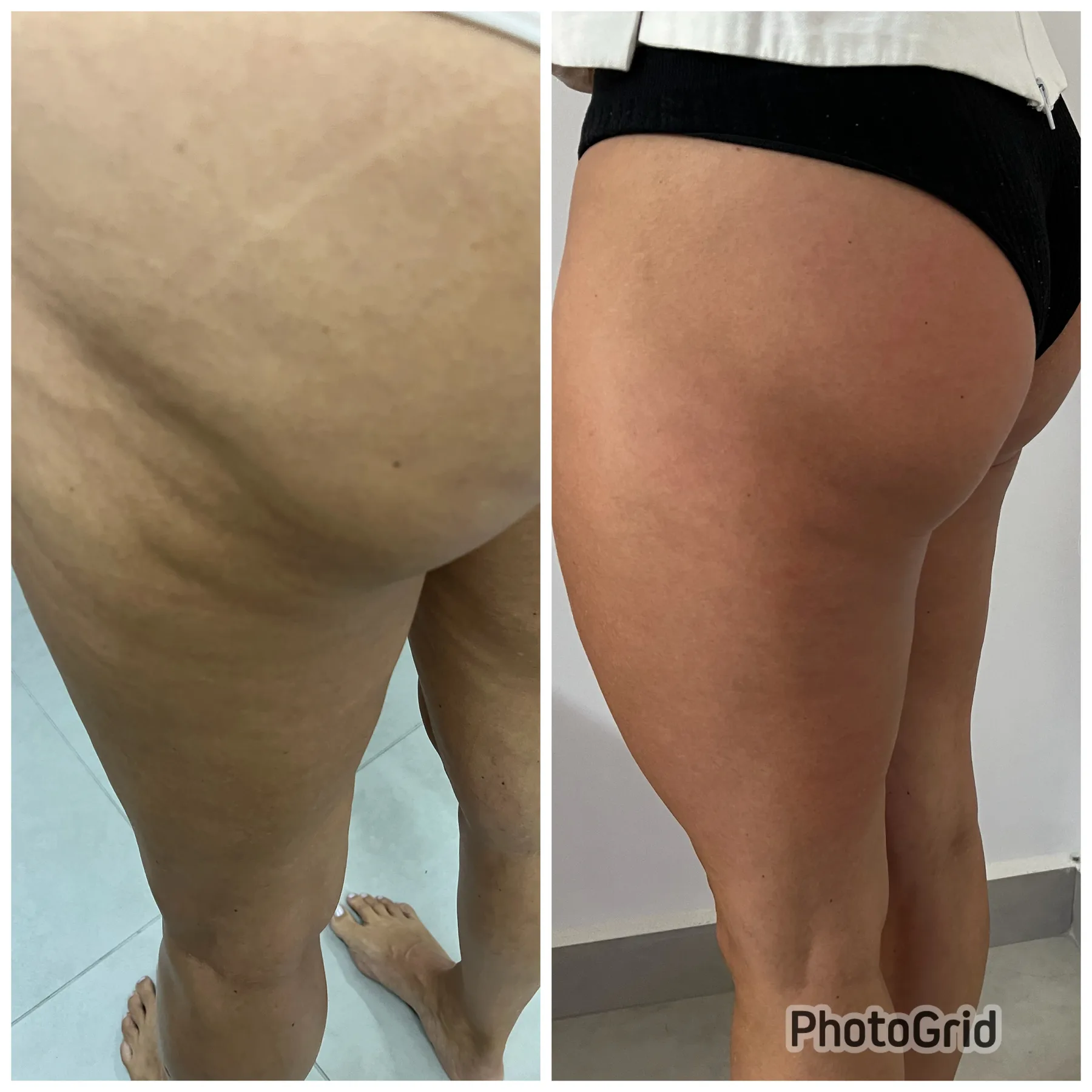 Bioestimulador nos Glúteos - La Forme Center