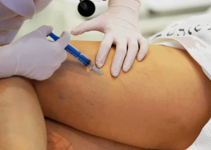 Profissional com luvas realizando procedimento injetável em vasinhos superficiais na perna