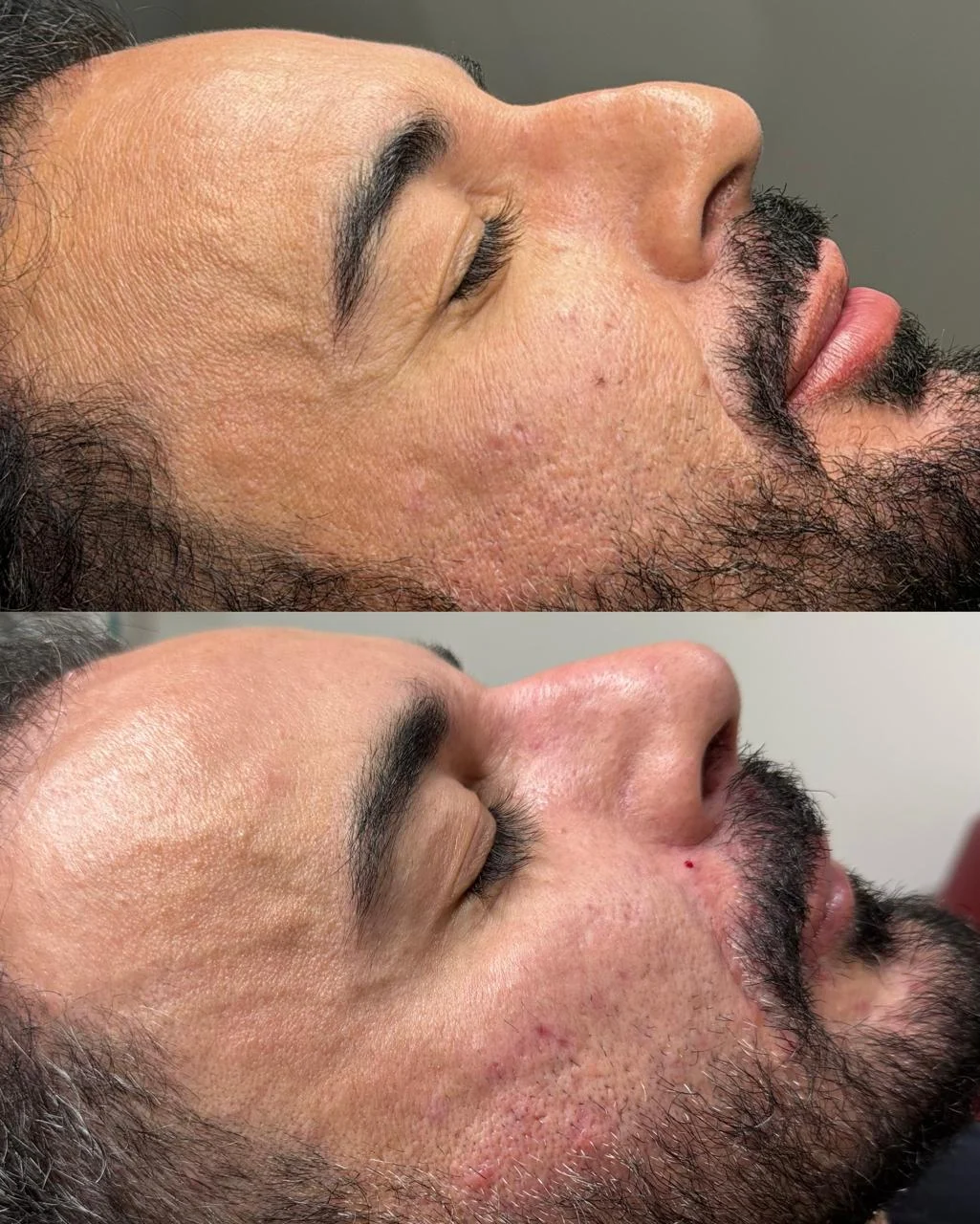 Comparativo fotográfico de perfil facial relacionado a tratamento de rinomodelação